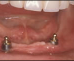 case-11-b-implant-2
