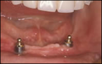 case-11-b-implant-2