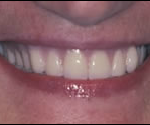 dental implant 1