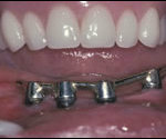 dental implant 1