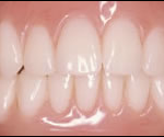 case-11-a-implant