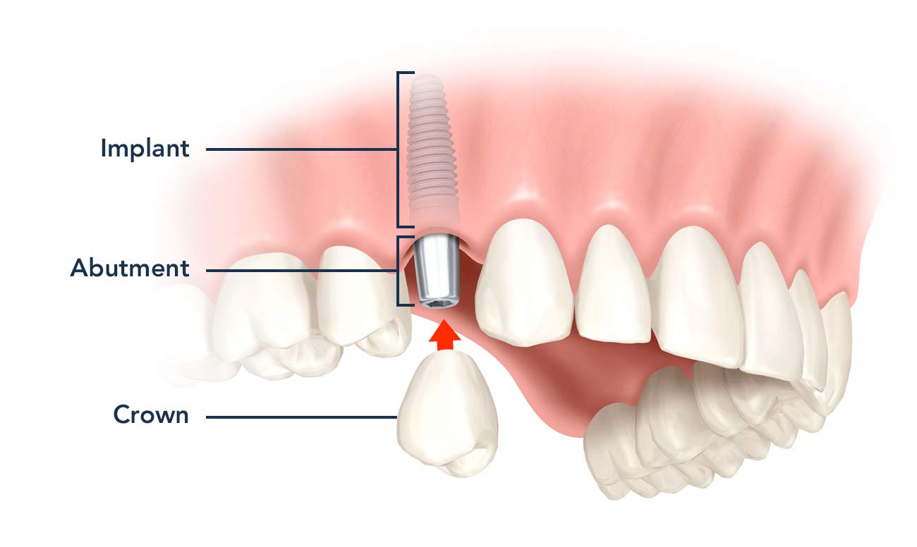 dental implants hemel hempstead